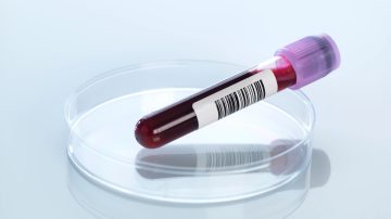 Kolay bir kan testiyle Alzheimer’ı erkenden teşhis etmek mümkün olabilir